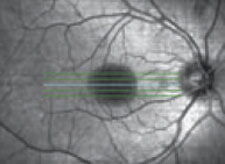 Abbildung - Chorioretinitis centralis serosa