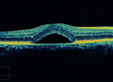 Abbildung - Chorioretinitis centralis serosa